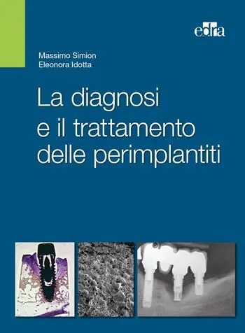 La diagnosi e il trattamento delle perimplantiti Flitsaanbieding