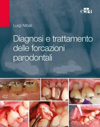 Laatste Kans Diagnosi e trattamento delle forcazioni parodontali